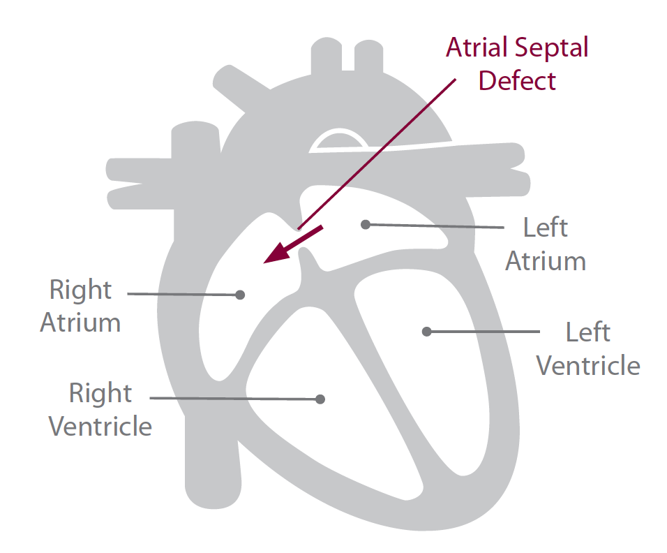 atrial septal defect