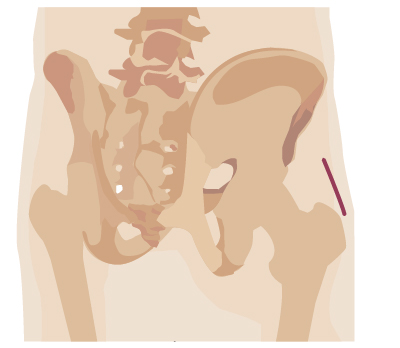 Robotic surgery incision from hip surgery