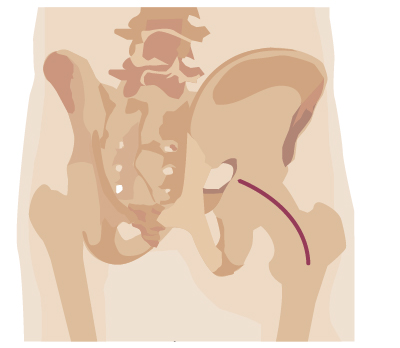 Traditional surgery incision from hip surgery