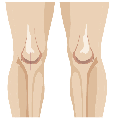 Robotic surgery incision from knee surgery