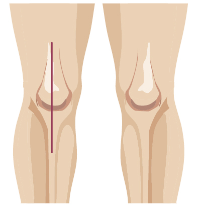 Traditional surgery incision from knee surgery